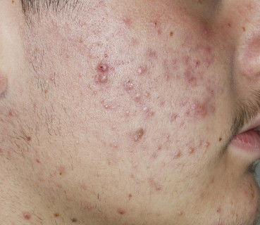 Is Acne Related To Food